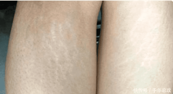说白了|女生腿上的一圈圈线是什么？它们是由肥胖引起的吗？ 3招有效消除它们